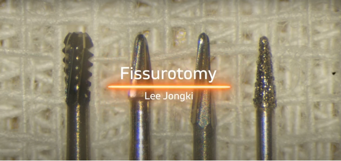 Dr. Lee, Fissurotomy