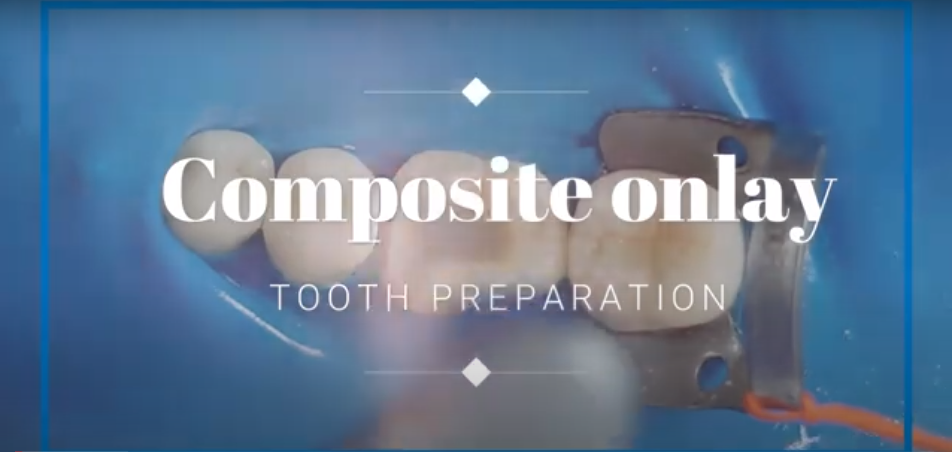 Dr. Yanikian, Tooth preparation for composite onlay - English