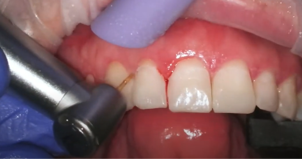 Dr. Alkisti, Finishing and polishing of anterior composite