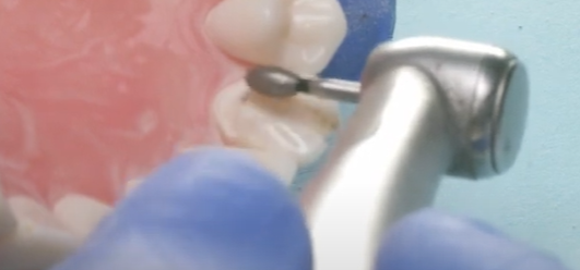 Dr. Goldstein, Anterior Crown Prep: Step 2