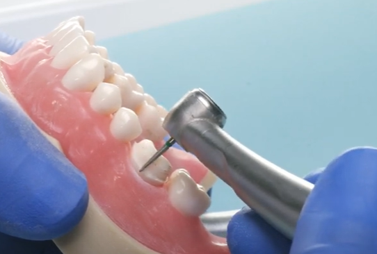 Dr. Cary Goldstein, Posterior Crown Fit