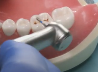 Dr. Goldstein, Occlusal Prep