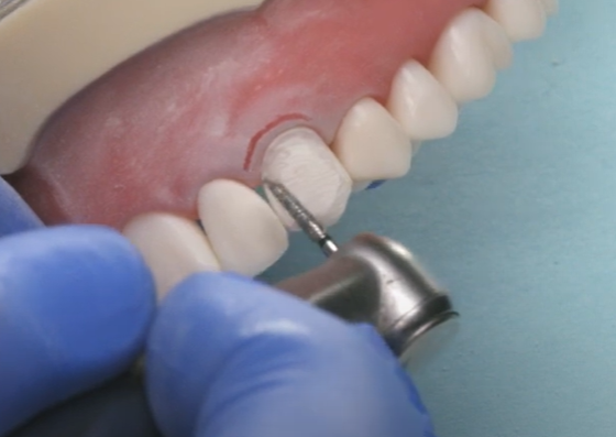 Dr. Goldstein, Veneer Prep:  Step 2