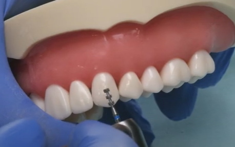 Dr. Goldstein, Veneer Prep:  Step 1