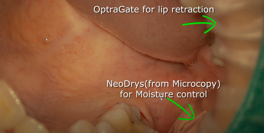 Dr. Lee MTA pulpotomy (with NeoDrys)