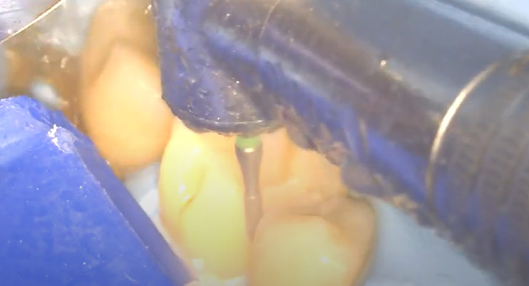 Dr. de Beer, The Direct Composite Quadrant - Full length video