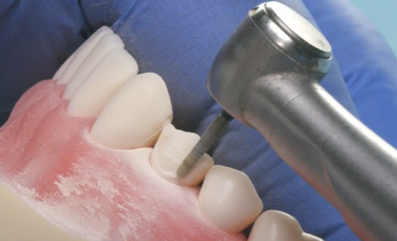 Dr. Goldstein, Premolar Veneer Prep:  Step 2