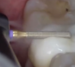Dr. Ilja Pestov, Zirconia crown removal/ adjustment