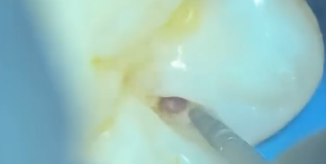 Dr. Georg Benjamin, Minimal Invasive restoration