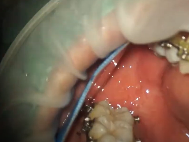 Dr. Lee Dental resin filling