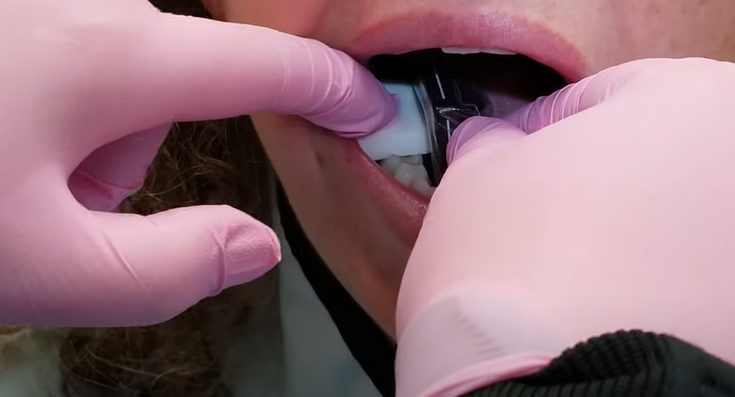 Hygiene Edge - Digital Dental Bitewing Tips