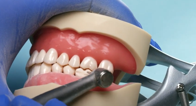 Dr. Cary Goldstein, Crown Prep Mistakes