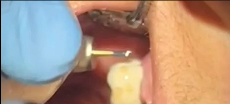 Dr. Hugo Urena, NeoMax2 removal of metal crown