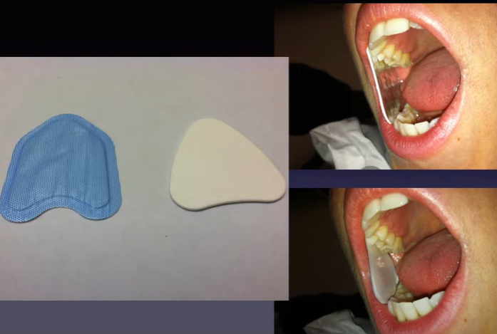 Mark Frias, RDH Dri Angle vs. NeoDrys