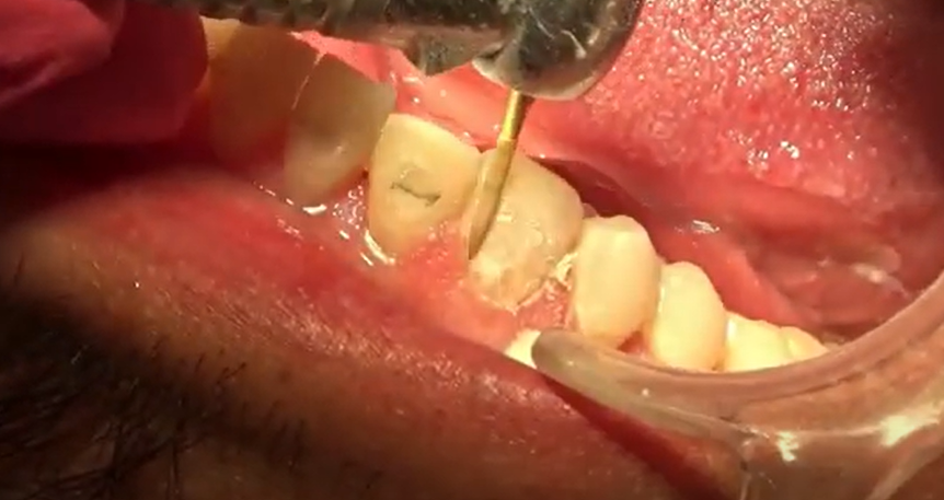 Dr. Jaimee Morgan, Long version: Orthodontic Adhesive Removal