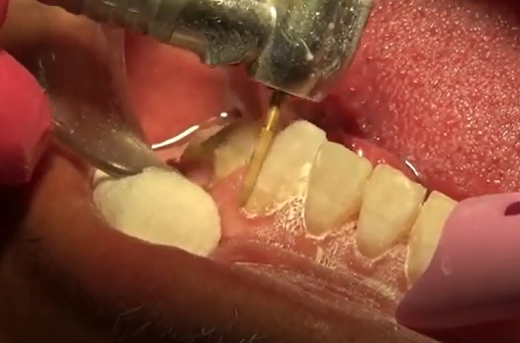 Dr. Jaimee Morgan, Short version: Orthodontic Adhesive Removal